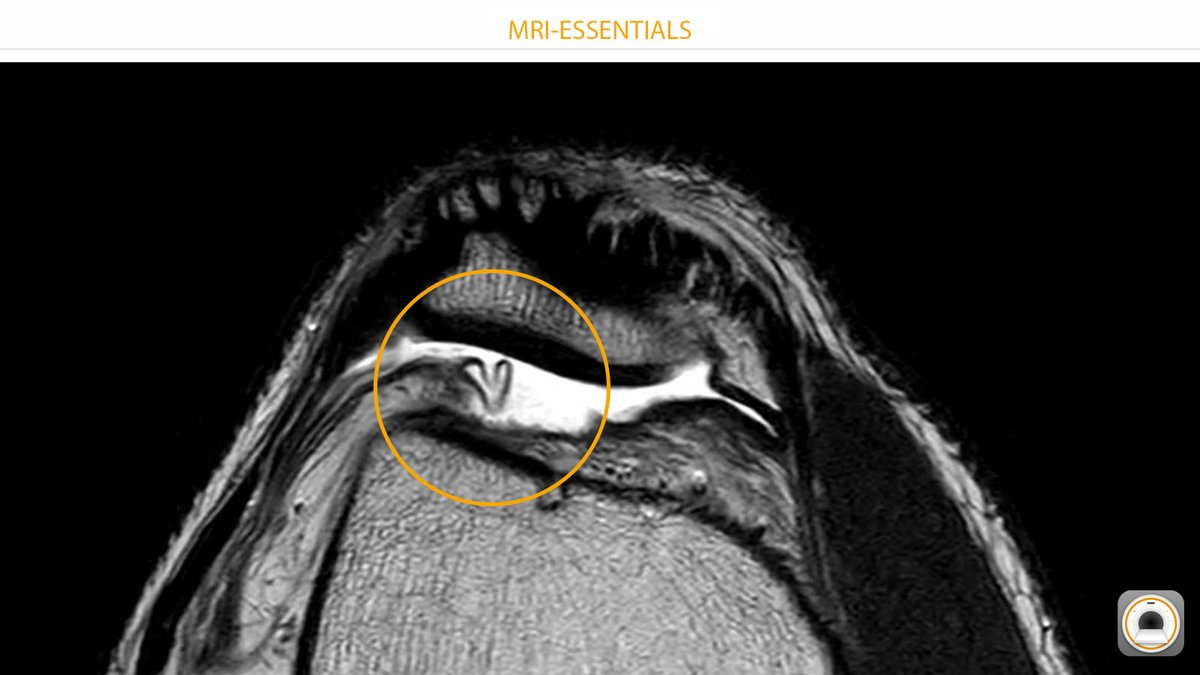 EssentialsMri's tweet photo. The suprapatellar plica and MRI-ESSENTIALS wish you a Happy New Year 2024! 🙂
#mskrad #orthotwitter #radres #radiology https://t.co/adQewsu4Gq