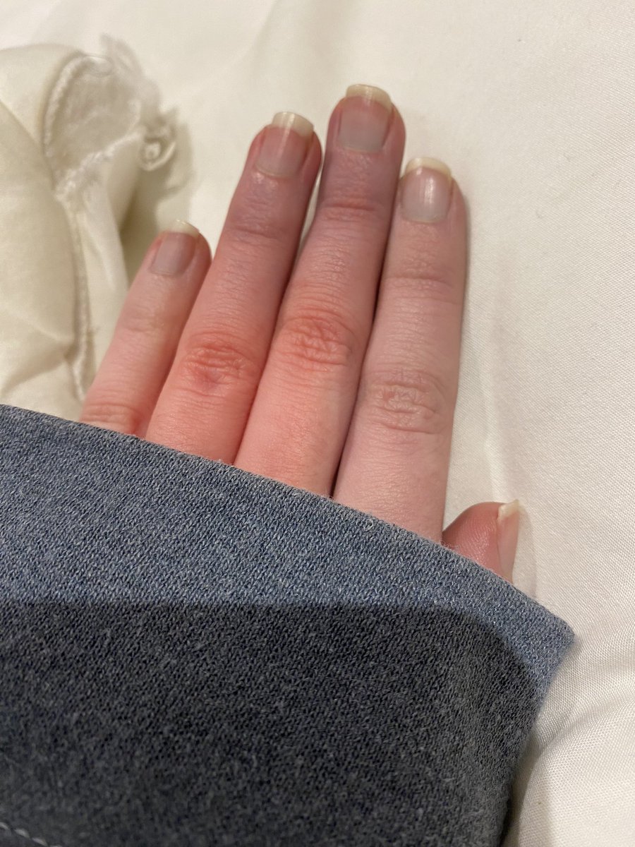 liaromic's tweet photo. think I might have raynauds lol https://t.co/E8F1PJqzsz