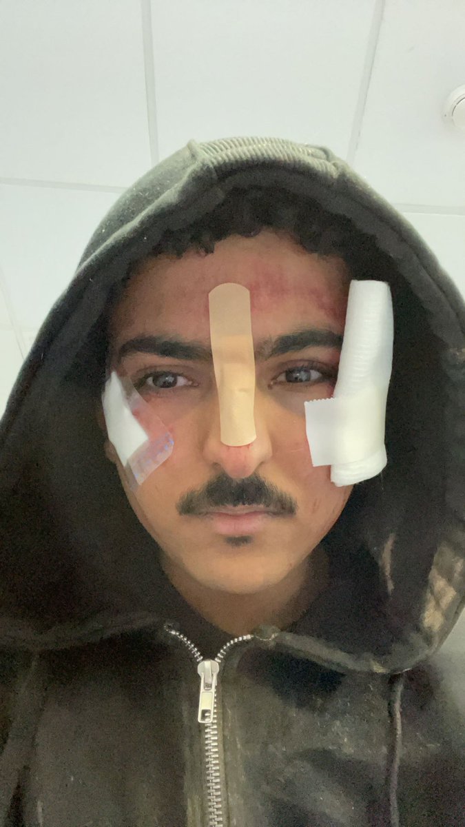 mfmnf's tweet photo. الحمدالله قدر الله وما شاء فعل اليوم كنت منطلق بالخيل و هي شافت شى و جفلة و ركضت باسره شى حاولت اوقفها بس مافي امل جيت بنط و انا مافيني شعور توتر ولا خوف ابدا بس سبحان الله  ربي لطف و اغمى علي قبل ما انط و ابشركم رحت المستشفى سو لي اشعه و رنين مغناطيسي سليم ١٠٠٪ لس كدمات و رضوض بالوجة