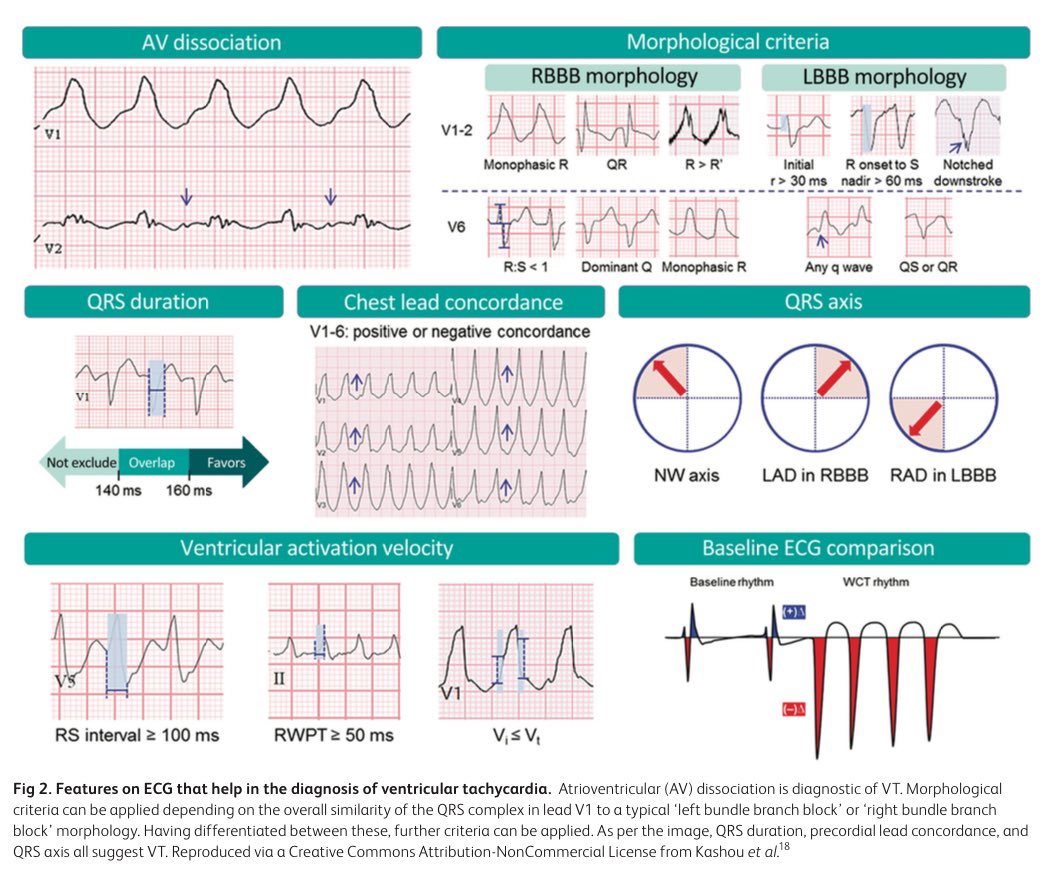 🚨 Taquicardia #Ventricular: Diagnóstico y Manejo 🫀

🔹 #Definición y Características 📈
   - La TV es una arritmia con una frecuencia >100 latidos por minuto.
   - Proviene del miocardio ventricular o del tejido de conducción especializado debajo del haz atrioventricular