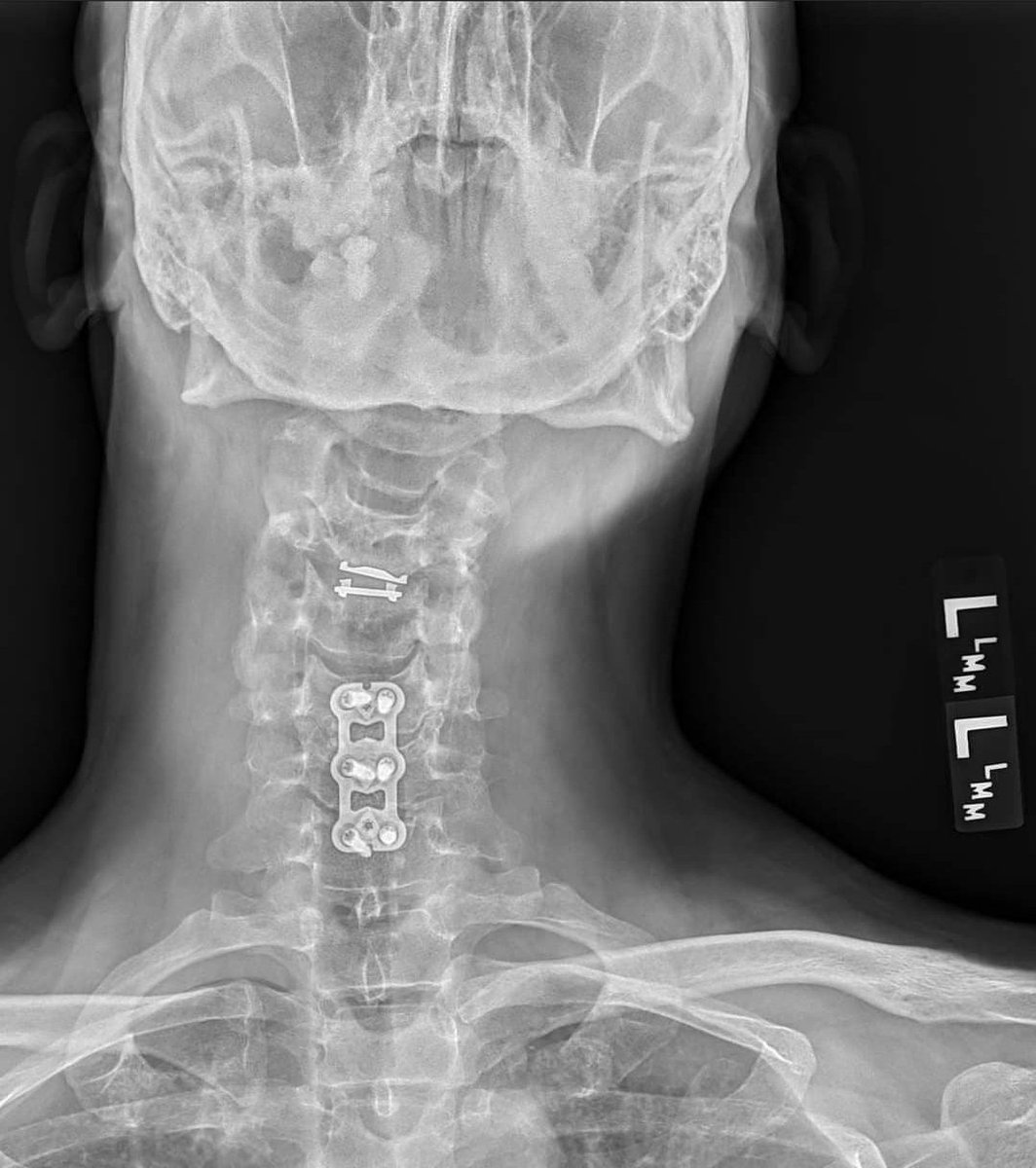 TheNerdyDan's tweet image. Day 1 of posting this. I will continue to post the same thing (without images) daily until doctors fix up the rest of my neck. Dear Spine Surgeons or Neurosurgeons, please fix this and get me back to a normal life!
