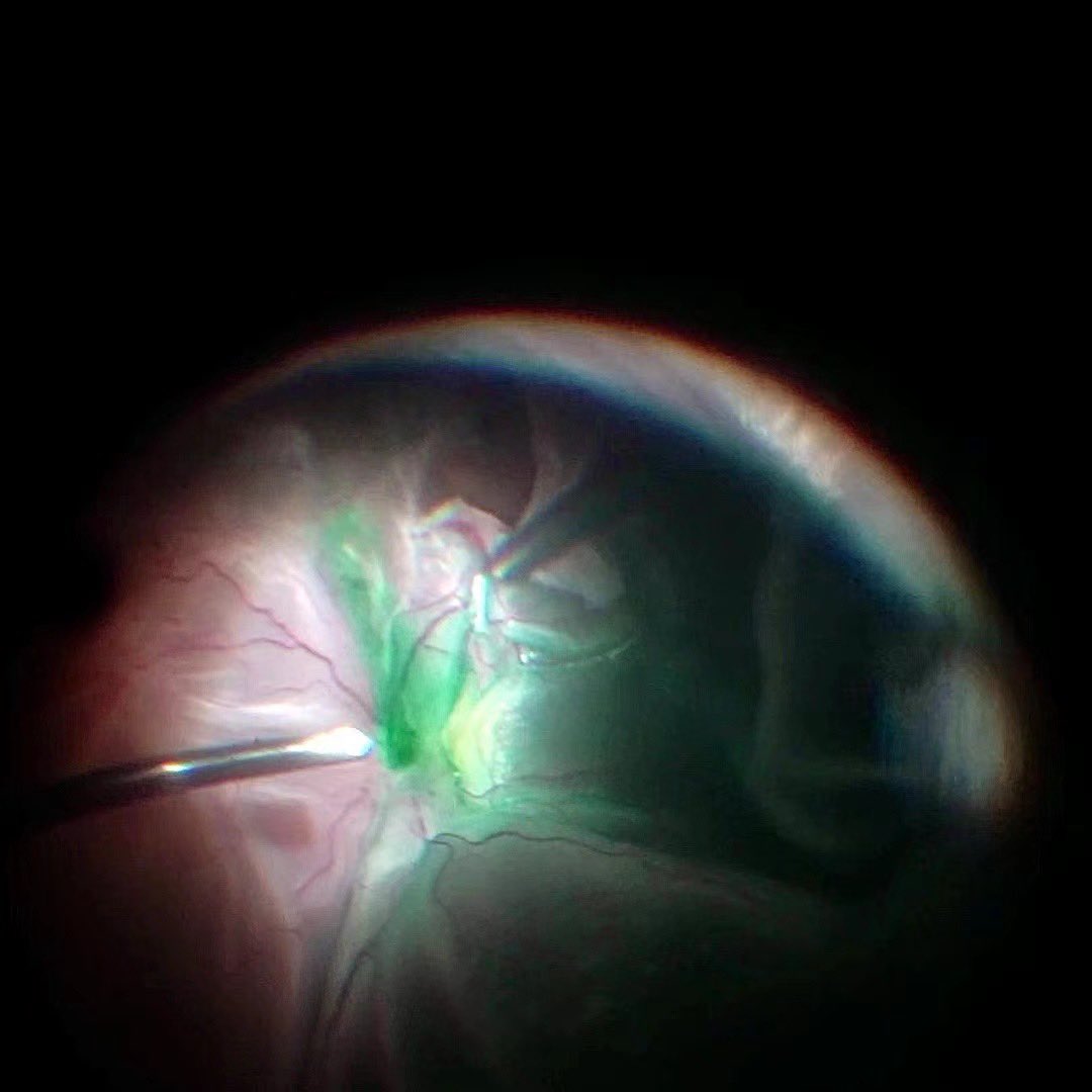 newvisionmed's tweet photo. DIY retinal surgery video recoding via Sony a7 Nex camera https://t.co/aDeaYjMqVC