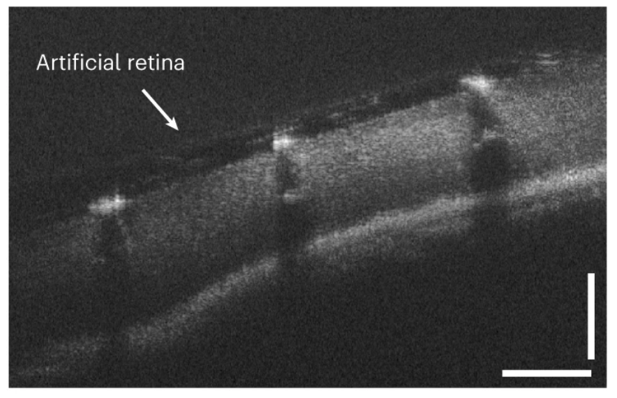 NikoMcCarty's tweet photo. Five biotechnology papers published in the last two days.

1. An artificial retina restores object recognition in mice.

Made from an array of printed microelectrodes, the device was implanted into mice. Shining light onto a fully deteriorated retina triggered a neural response. https://t.co/Bu2eziIHbs