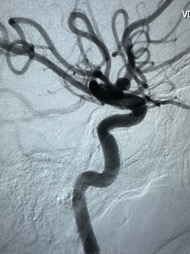 PenNeuro's tweet photo. US HCPs: A1-A2 junction aneurysm managed with #PXSlim advanced through distal A1 stenosis to deliver a single 3mmx5cm #PC400 coil. System supported with #BMX81 placed in high cervical. Courtesy of Dr. Liu.
Rx only. For risk info: https://t.co/hzWEQEPOqr Clinical results may vary https://t.co/Bja0Gbr8oY