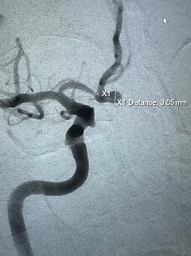 PenNeuro's tweet photo. US HCPs: A1-A2 junction aneurysm managed with #PXSlim advanced through distal A1 stenosis to deliver a single 3mmx5cm #PC400 coil. System supported with #BMX81 placed in high cervical. Courtesy of Dr. Liu.
Rx only. For risk info: https://t.co/hzWEQEPOqr Clinical results may vary https://t.co/Bja0Gbr8oY