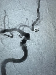 PenNeuro's tweet photo. US HCPs: A1-A2 junction aneurysm managed with #PXSlim advanced through distal A1 stenosis to deliver a single 3mmx5cm #PC400 coil. System supported with #BMX81 placed in high cervical. Courtesy of Dr. Liu.
Rx only. For risk info: https://t.co/hzWEQEPOqr Clinical results may vary https://t.co/Bja0Gbr8oY