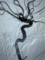 PenNeuro's tweet photo. US HCPs: A1-A2 junction aneurysm managed with #PXSlim advanced through distal A1 stenosis to deliver a single 3mmx5cm #PC400 coil. System supported with #BMX81 placed in high cervical. Courtesy of Dr. Liu.
Rx only. For risk info: https://t.co/hzWEQEPOqr Clinical results may vary https://t.co/Bja0Gbr8oY