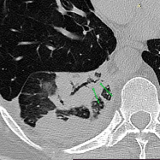 interneumo's tweet photo. INSOLITO!!! y misterio parcialmente resuelto: Hilo de sutura dentro del bronquio basal derecho comportándose como cuerpo extraño endobronquial obstruyendo el bronquio comun de los segmentos basales y produciendo infección crónica y colapso pulmonar segmentario basal (1). https://t.co/oGzCg3Z975