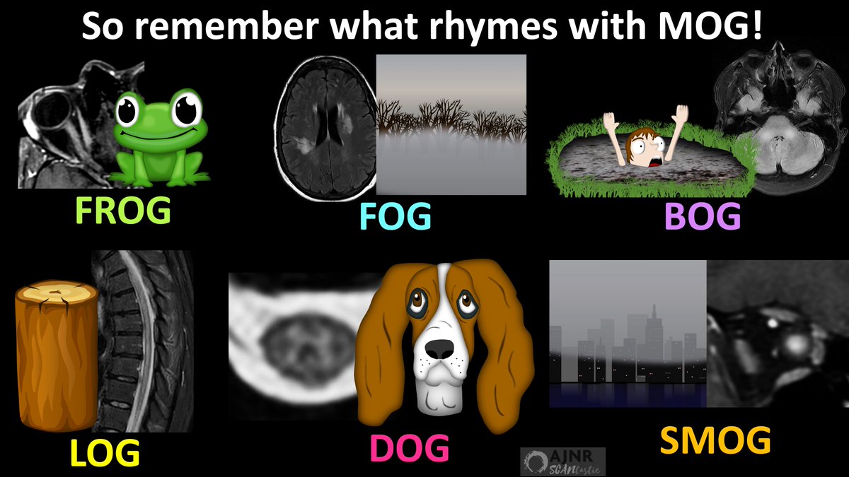 TheAJNR's tweet photo. 20/So next time you have imaging for demyelination, remember to look for all the signs of MOGAD that rhyme with MOG:

FROG: Optic neuritis
FOG: ADEM
BOG: Hindbrain involvement
LOG: Transverse myelitis
DOG: Cord H sign
SMOG: Hazy enhancement https://t.co/NeaUB7mghJ