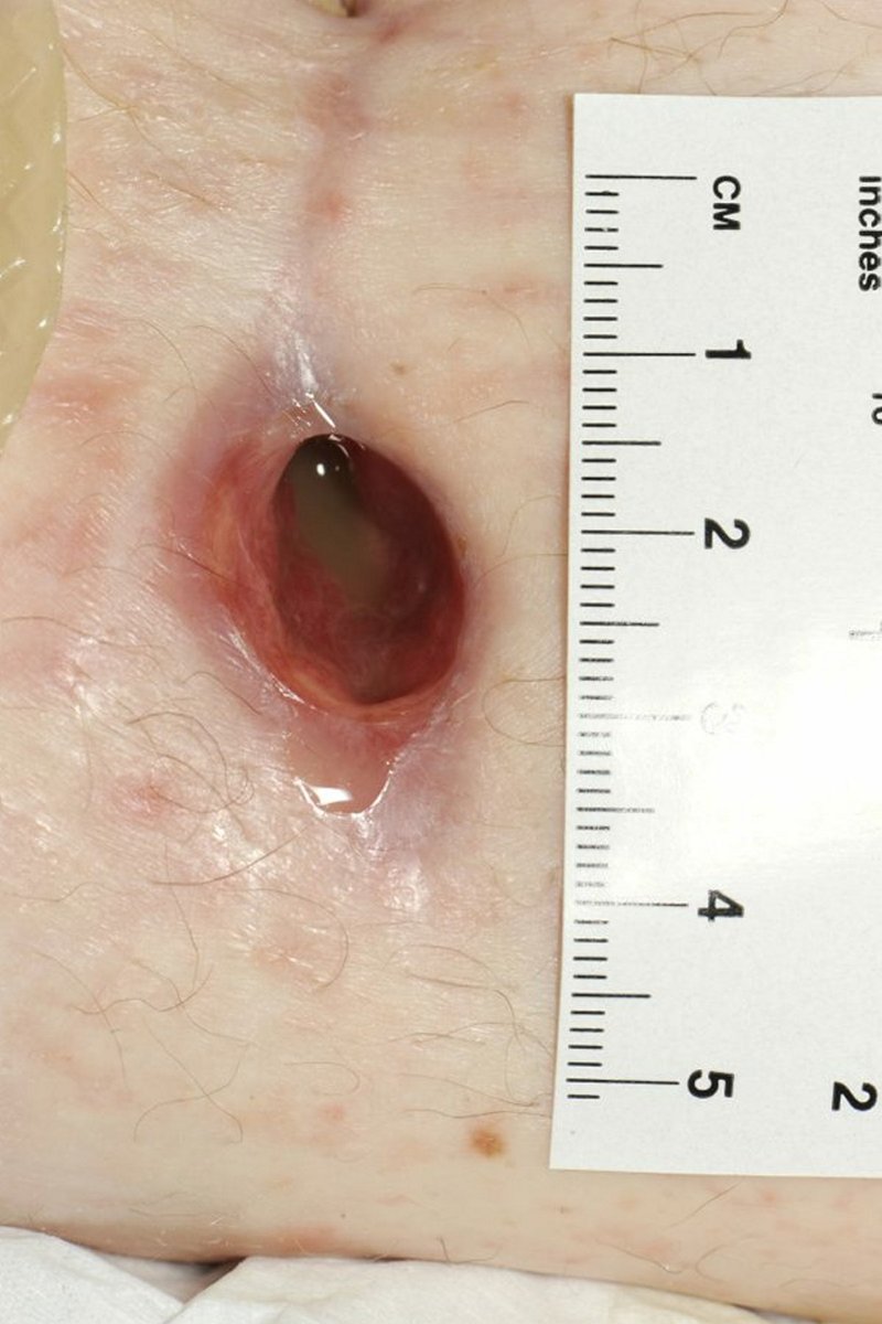 Take a look at this recent article by Joy Tickle addressing the challenges of cavity wounds in clinical practice! woundcare-today.com/journals/issue… #WWIC #woundcaretoday #woundhealing
