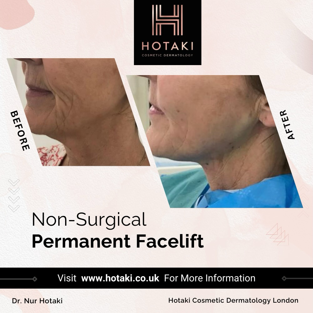 #drhotaki #hotakilondon #nonsurgicalaesthetics #aesthetictreatment #hotakicosmeticdermatology #noninvasive #nonsurgical #lowerfacelift #nonsurgicallowerfacelift #nonsurgical #nonsurgicalfacelift #facialrejuvenation #lowerfacelift #facelift