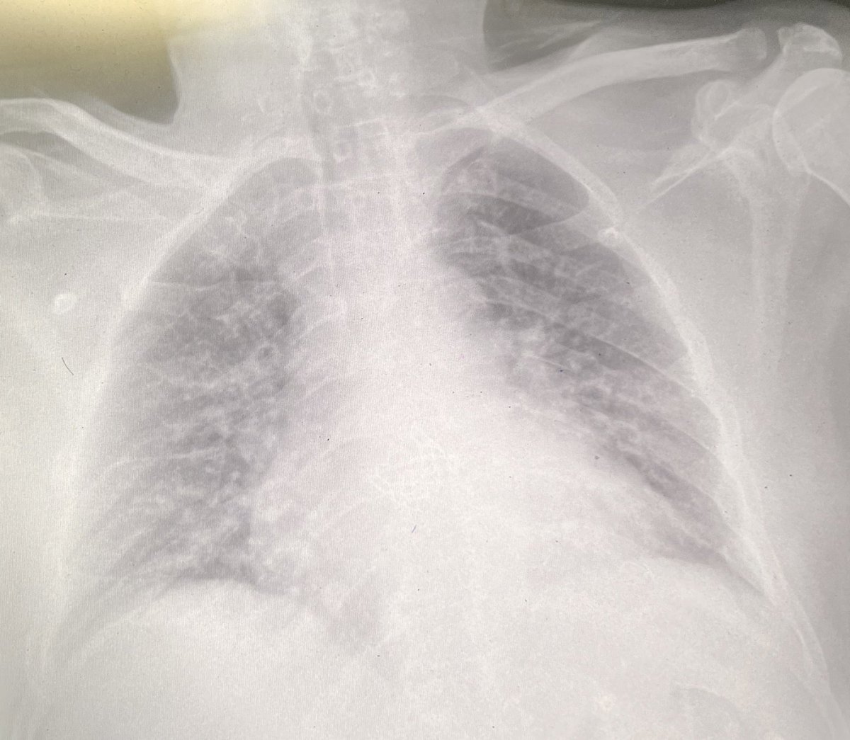 o_o_dr's tweet photo. امس جاني مريض عنده تاريخ مرضي فشل بعضلات (heart failure ) كان عنده انفلونزا قبل يوم،  واخذ بمستشفى خاص 
Paracetamol, 
azithromycin
 normal saline 1 L 
 وصل لطواري 
الاكسجين : ٨٨ وضغطه ١٥٤/٩٨، نبض ١٠٠

لماذا وصل المريض لهذا الحالة ؟ https://t.co/5UdX3TRB7l