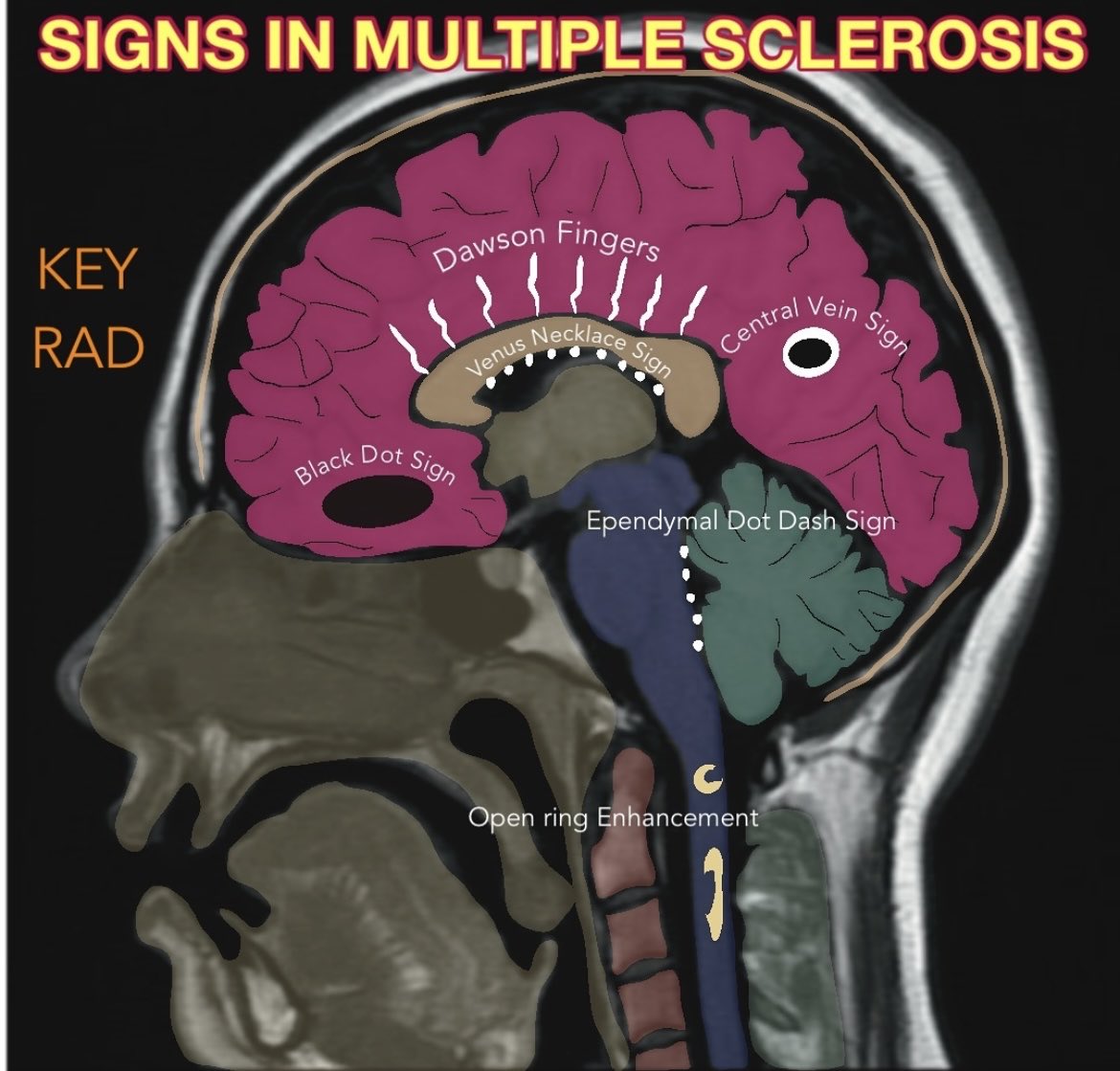 OGdukeneurosurg's tweet photo. Multiple sclerosis mri signs from key rad https://t.co/jgvBaiRIo3
