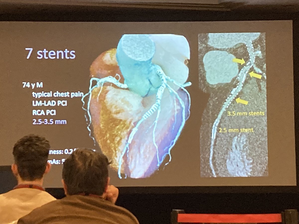 🫀Stent - no problem. 7 stents - still no problem 😱 #PhotonCounting #SCCTBudapest #YesCCT @SiemensHealth @Heart_SCCT 🍩🧛‍♂️🧛‍♂️🔢