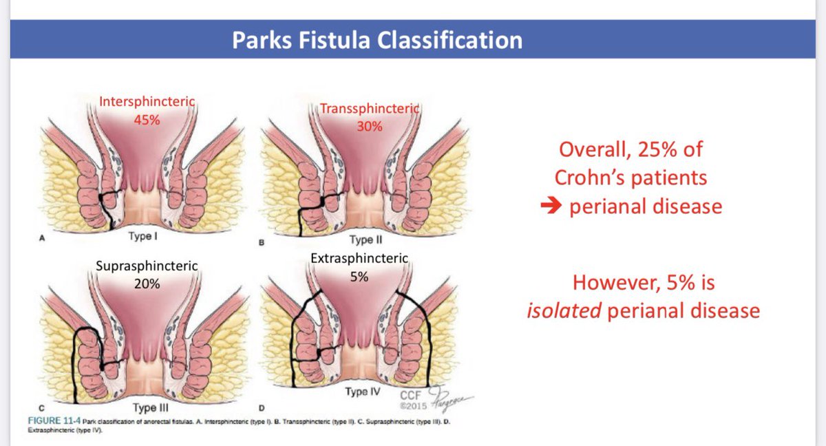amjohnsonMD's tweet photo. @MRegueiroMD on perianal fistulas in CD: 
▶️ 5% may have isolated perianal CD
▶️ perianal fistulas require ⬆️ IFX levels btwn 10 to 20
▶️ UPA appears to have signal for tx perianal dz 
▶️ Future of stem cells unclear: ideal pt w/ single epithelialized tract, no inflammation/infxn https://t.co/Zo2Hq113E4