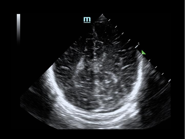 POCUSJournal's tweet image. ⚡️ Real stories, real impact: Learn how 🧠 #POCUS is expediting care for children with intracranial pathologies  
🔗 pocusjournal.com/article/16435/
#PatientCare #POCUSImpact #FOAMed
