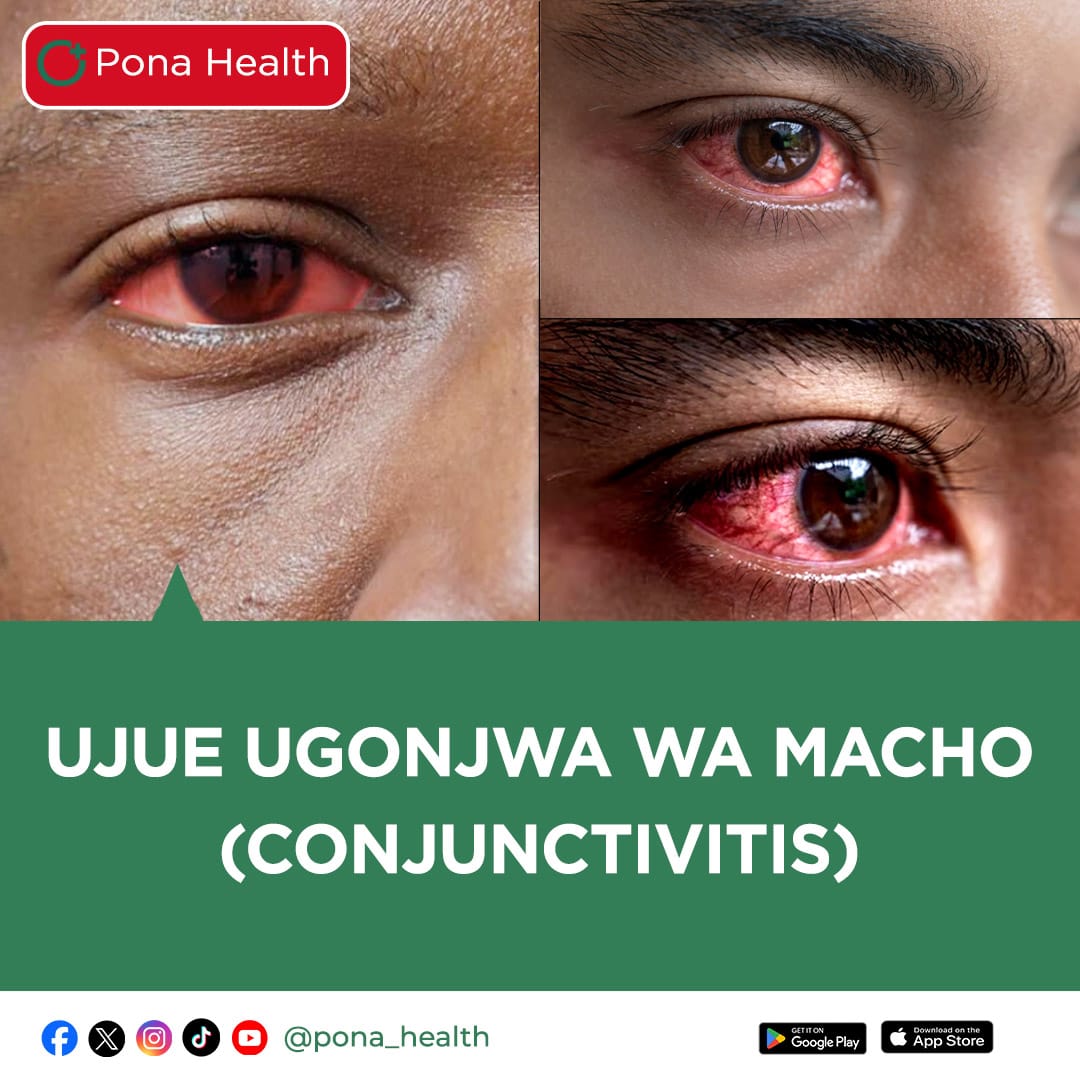 Pona_health's tweet photo. Conjunctivitis Ni ugonjwa wa kuambukiza ambao huathir macho na hivyo macho kuonekana mekundu.Husababishwa na Virusi aina ya Adenovirus ambapo huenea kutoka kwa mgonjwa kwenda kwa mwingine kupitia matone,kugusana au kuchangia vitambaa vyenye virusi kutoka kwa mgonjwa
#conjucivitis https://t.co/N9soNaxzDP