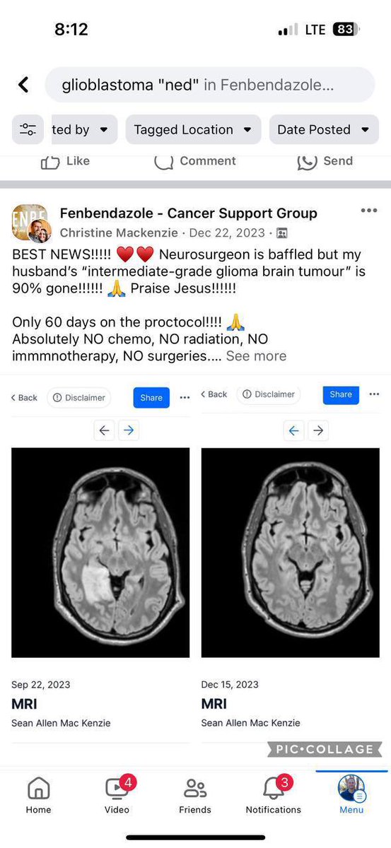 二氧化氯是好東西, 但排毒還有別的選擇 🧐

自然療法治腦瘤

———————————————
最好的消息！！！！ ♥️♥️ 神經外科醫生很困惑，中級神經膠質瘤腦瘤已經消失了 90%！！！！！ 🙏 讚美耶穌！！！！！！

協議只有60天！！！！ 🙏
絕對沒有化療、沒有放療、沒有免疫治療、沒有手術。