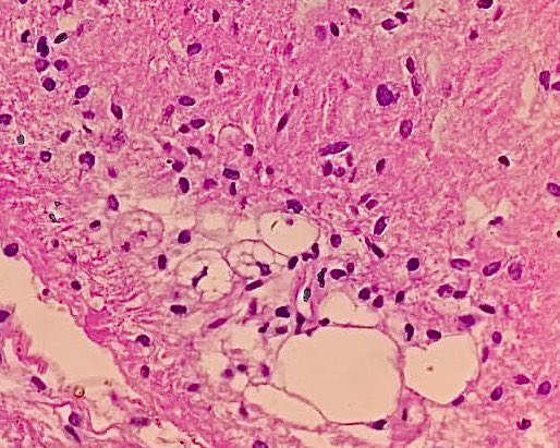 Spotting some lipoblasts in a retroperitoneal mass in a 51 year old female. #PathTwitter #histopathology #PathX #BSTpath #liposarcoma