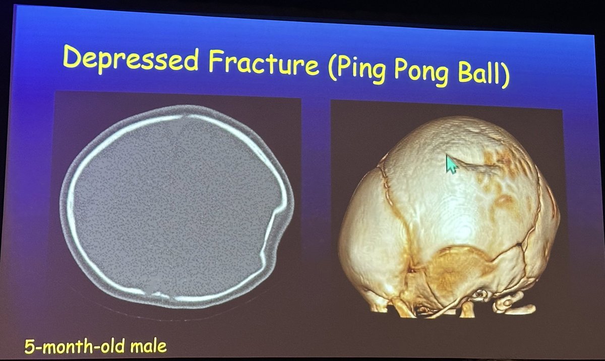 A great review of Pediatric Skull Fractures & Suture Variants by Dr. Cory Pfeifer from @PhxChildrens at #ASPNR24! @The_ASPNR #PediNeuroRad #NeuroRad