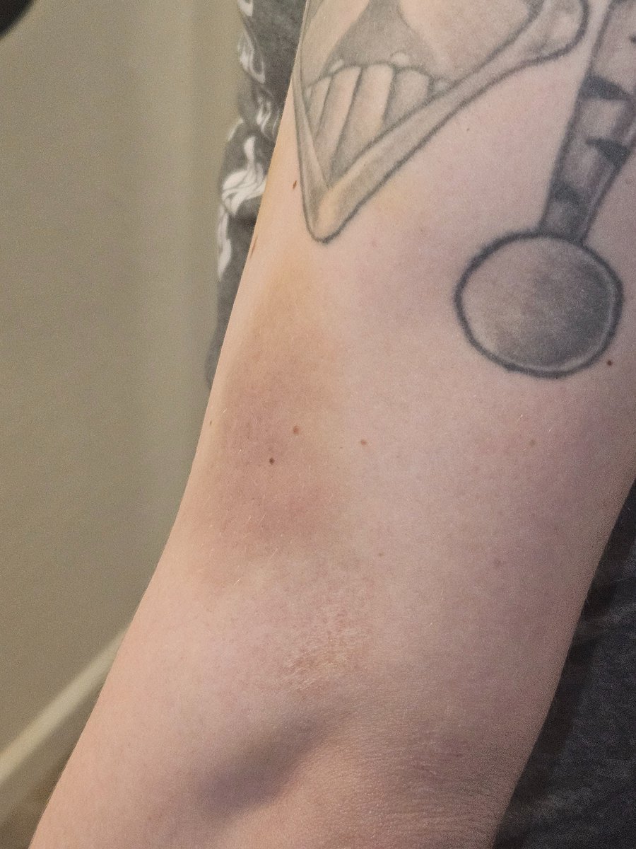 FawntheDon's tweet photo. @abc15 @Timcast the bruises I received when they triggered my ptsd and fought me instead of backing away and deescalating https://t.co/0GWwpLA2YC