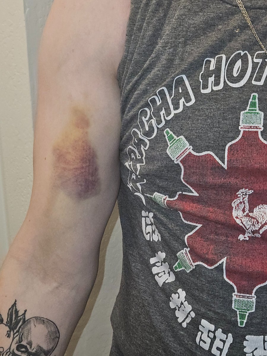 FawntheDon's tweet photo. @abc15 @Timcast the bruises I received when they triggered my ptsd and fought me instead of backing away and deescalating https://t.co/0GWwpLA2YC