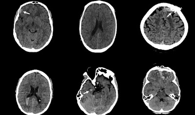 Radiology_AI's tweet photo. Vision Transformer-based Decision Support for Neurosurgical Intervention in Acute Traumatic Brain Injury: Automated Surgical Intervention Support Tool (ASIST-TBI) https://t.co/QA8sph97e9 @armaankm @cwitiw @UofTSurgery #TBI #trauma #DeepLearning https://t.co/AQigbA2Fus