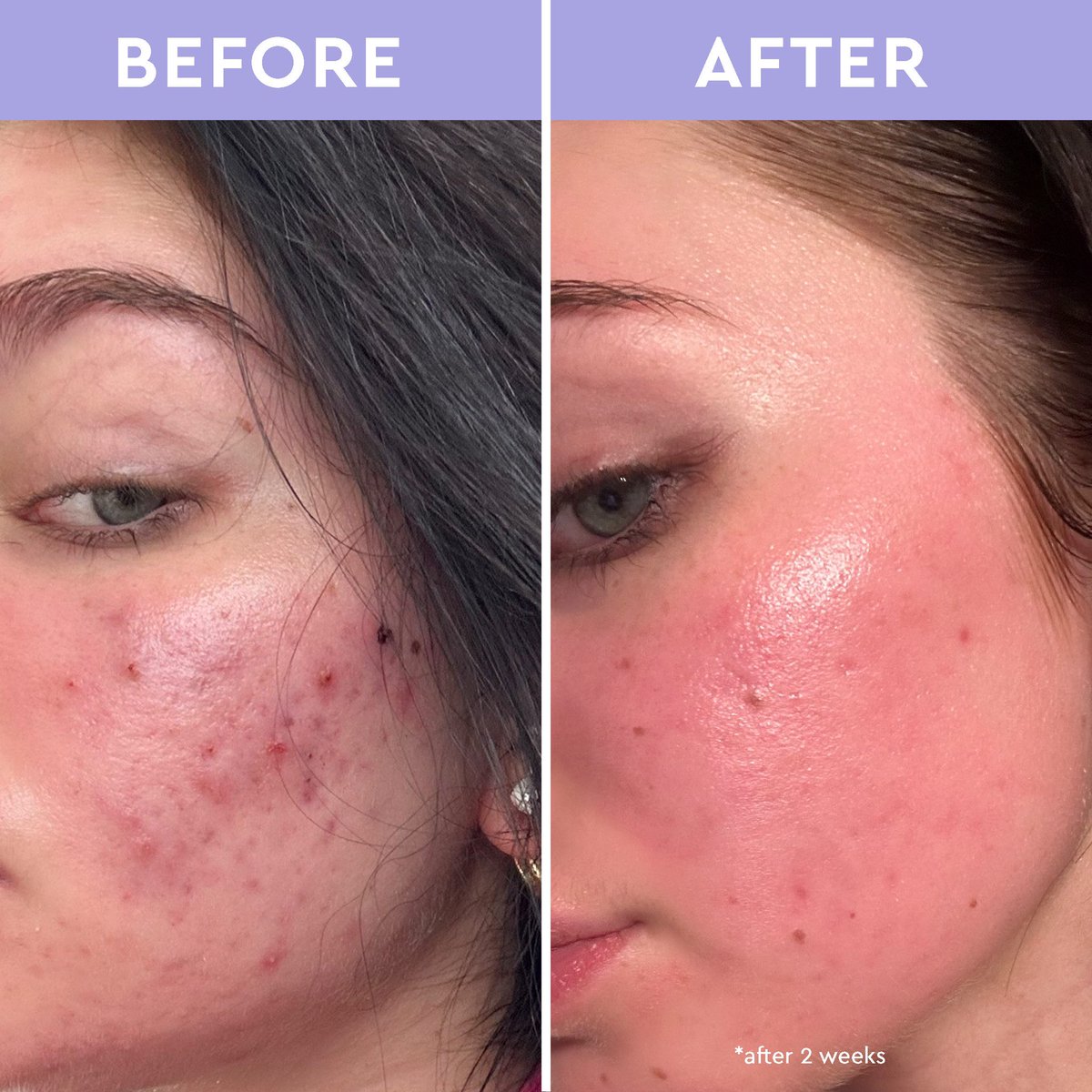 the results speak for themselves... 🤩 savanna used our spot a spot acne exfoliating acne solution to help break up dead skin cells, dirt and oil for happy looking skin! ✨ shop now at @ultabeauty and florencebymillsbeauty.com #florencebymills 📸 @savannafaithyoung