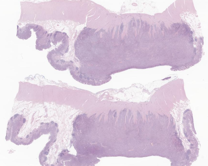 EricMadPatho's tweet photo. 64/M proximal gastrectomy. Gastric carcinoma with lymphoid stroma (GCLS), strong EBV positivity illustrated by in situ hybridization. Characteristic ribbon-like architecture near the mucosa. Reason to watch out for lymphoid stomach Bx! #GIpath #pathresidents #PathX https://t.co/xrXLGi9NnJ