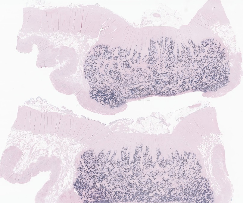 EricMadPatho's tweet photo. 64/M proximal gastrectomy. Gastric carcinoma with lymphoid stroma (GCLS), strong EBV positivity illustrated by in situ hybridization. Characteristic ribbon-like architecture near the mucosa. Reason to watch out for lymphoid stomach Bx! #GIpath #pathresidents #PathX https://t.co/xrXLGi9NnJ