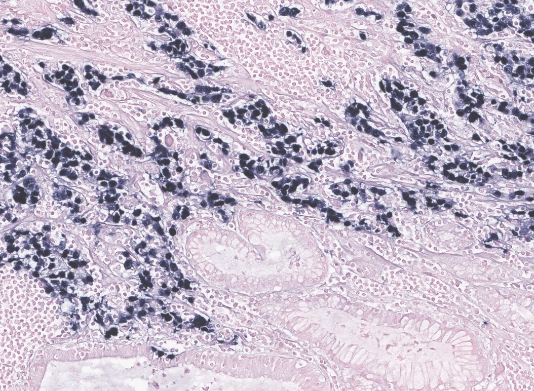 EricMadPatho's tweet photo. 64/M proximal gastrectomy. Gastric carcinoma with lymphoid stroma (GCLS), strong EBV positivity illustrated by in situ hybridization. Characteristic ribbon-like architecture near the mucosa. Reason to watch out for lymphoid stomach Bx! #GIpath #pathresidents #PathX https://t.co/xrXLGi9NnJ