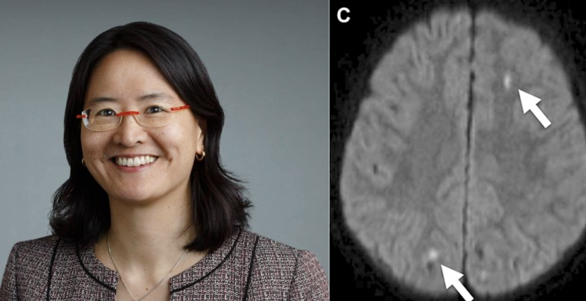IDKD (@idkdcourse) on Twitter photo Prof. Yvonne W. Lui from <a href="/nyulangone/">NYU Langone Health</a> will teach about "Head Trauma" at the upcoming IDKD 2024 in Davos. Check-out also this interesting review published in Neuroimaging Clin N Am about DWI in mild traumatic brain trauma. #neuroradiology #IDKD2024
ncbi.nlm.nih.gov/pmc/articles/P… Prof. Yvonne W. Lui from <a href="/nyulangone/">NYU Langone Health</a> will teach about "Head Trauma" at the upcoming IDKD 2024 in Davos. Check-out also this interesting review published in Neuroimaging Clin N Am about DWI in mild traumatic brain trauma. #neuroradiology #IDKD2024
ncbi.nlm.nih.gov/pmc/articles/P…