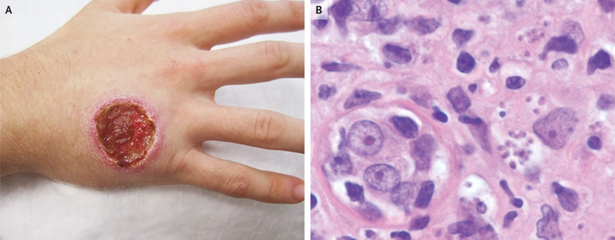 19 años♂️ , había trabajado en una finca de Ecuador: 3 meses de evolución de una úlcera (A).

Biopsia: infiltrado de linfocitos e histiocitos con organismos intracelulares …(B).
1/3

DOI: 10.1056/NEJMicm1908092
#dermatologia #microbiología