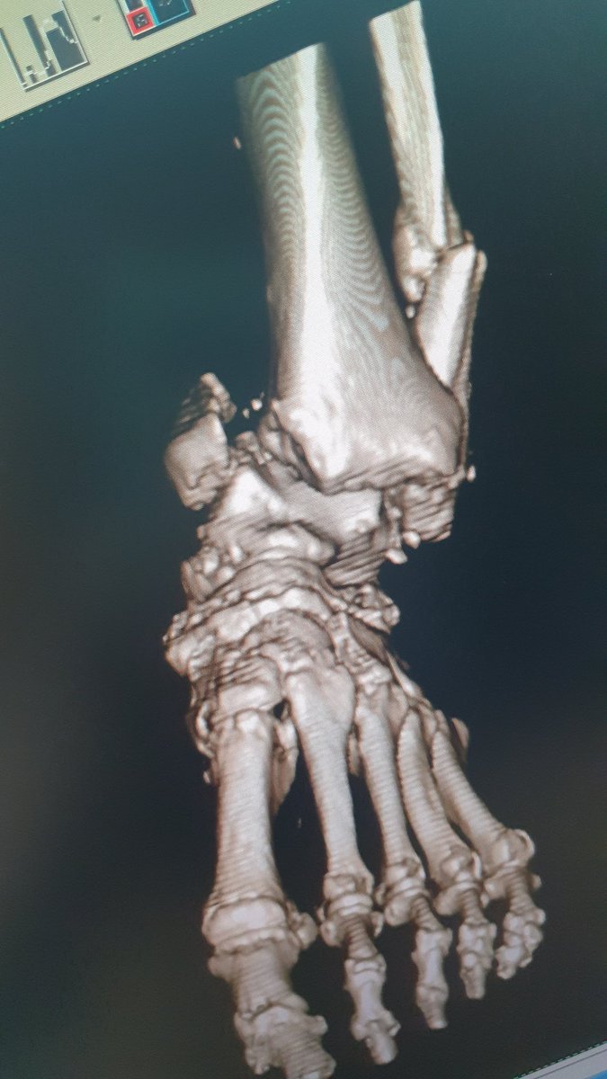 surgeonfk's tweet photo. Pantalar arthrodesis with tibial nail in neglected trimalleolar fracture dislocation ankle &amp; rheumatoid 🤕 https://t.co/rCetAk1zy9