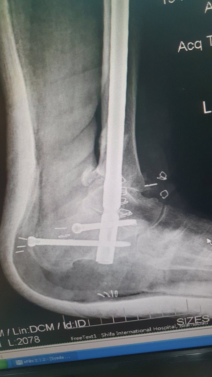 surgeonfk's tweet photo. Pantalar arthrodesis with tibial nail in neglected trimalleolar fracture dislocation ankle &amp; rheumatoid 🤕 https://t.co/rCetAk1zy9