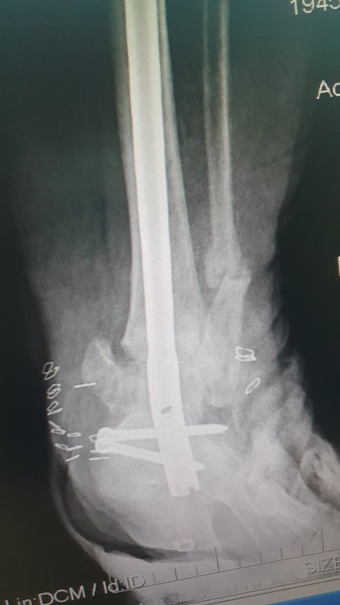 surgeonfk's tweet photo. Pantalar arthrodesis with tibial nail in neglected trimalleolar fracture dislocation ankle &amp; rheumatoid 🤕 https://t.co/rCetAk1zy9