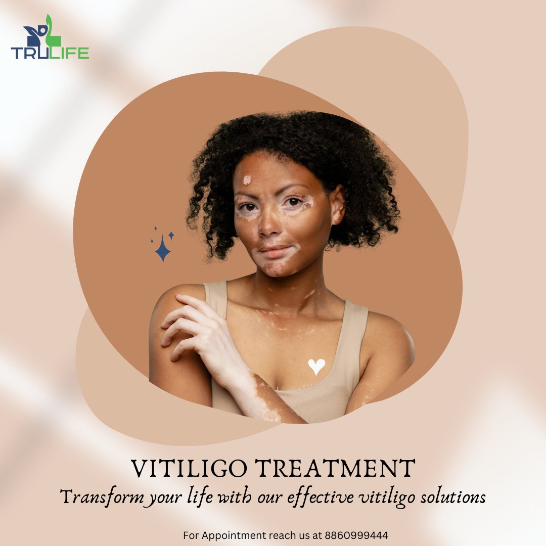 Unlock the beauty of diversity with Trulife Dermacare! Our Vitiligo Treatment is crafted to celebrate every unique shade. Embrace confidence in every step of your skin's transformation. 💙✨ #VitiligoTreatment #TrulifeDermatology #SkinRevival #ConfidenceUnveiled #UniqueBeauty