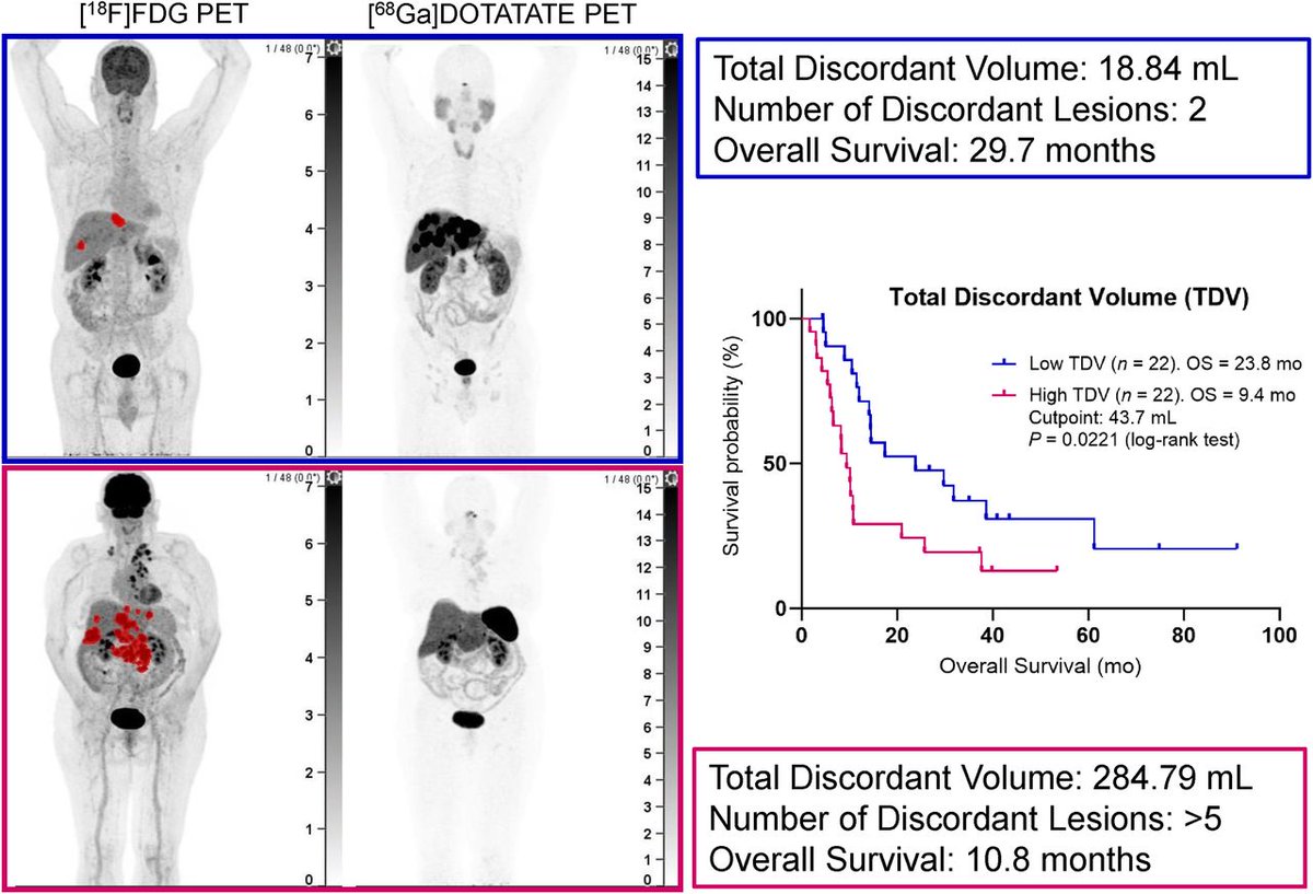 ¹⁸F-FDG PET/CT–avid discordant volume is a potential prognostic biomarker in patients with gastroenteropancreatic neuroendocrine neoplasms and should be investigated in future trials. ow.ly/om3V50Qmse3

#NuclearMedicine #NETCancer @DrDavidLChan