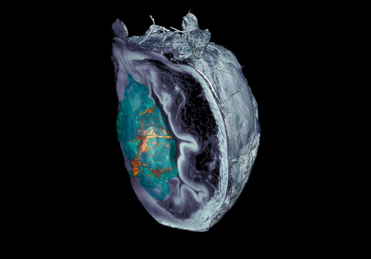 IRBBarcelona's tweet image. 🔬#IRBBarcelona has participated in a study, led by @IBECBarcelona and @CICbiomaGUNE, that demonstrates the effectiveness of self-propelled #nanorobots in shrinking bladder tumours by 90%.

📰@NatureNano

➡️bit.ly/3O2IN7P

📌DOI: 10.1038/s41565-023-01577-y

#IRBScience