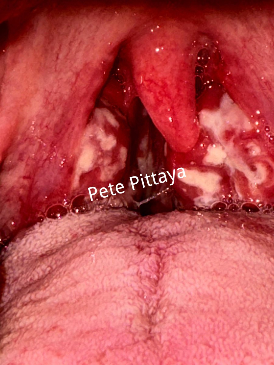 lekanoi's tweet photo. เริมในช่องปาก
Herpes Simplex.
แผลเริมในช่องปาก จะมีอาการเจ็บคอ บางรายอาจจะมีใข้ร่วม

ติดต่อจากการทำออรัลเซ็กซ์ https://t.co/hN0V9Uq9aA