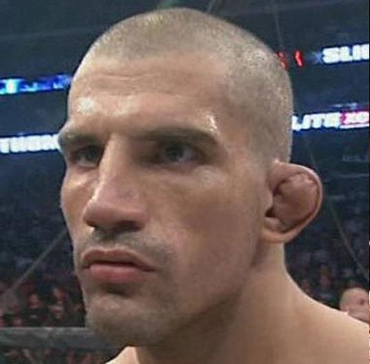 Las "orejas de coliflor" son una de las deformaciones más frecuentes en luchadores de artes marciales y otros deportes de contacto que se produce debido a un fuerte golpe o muchos golpes repetidos en esta zona del cuerpo.