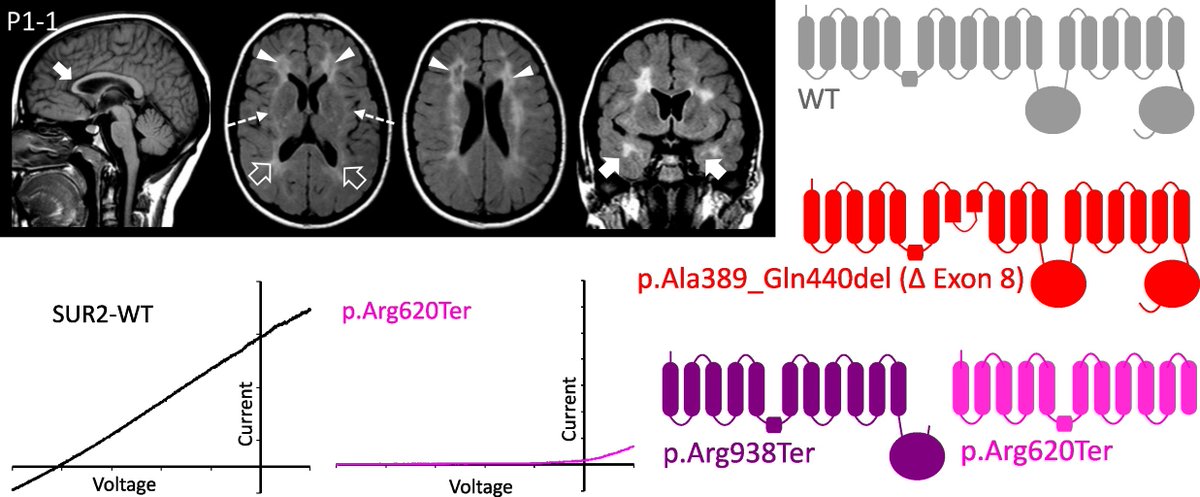Brain1878's tweet photo. Efthymiou et al. characterize nine individuals with ABCC9-related intellectual disability and myopathy syndrome (AIMS). All nine have homozygous loss-of-function variants in ABCC9, which encodes a regulatory subunit of ATP-sensitive potassium channels. https://t.co/ytsIm9ni42 https://t.co/Gmm3dPsiud