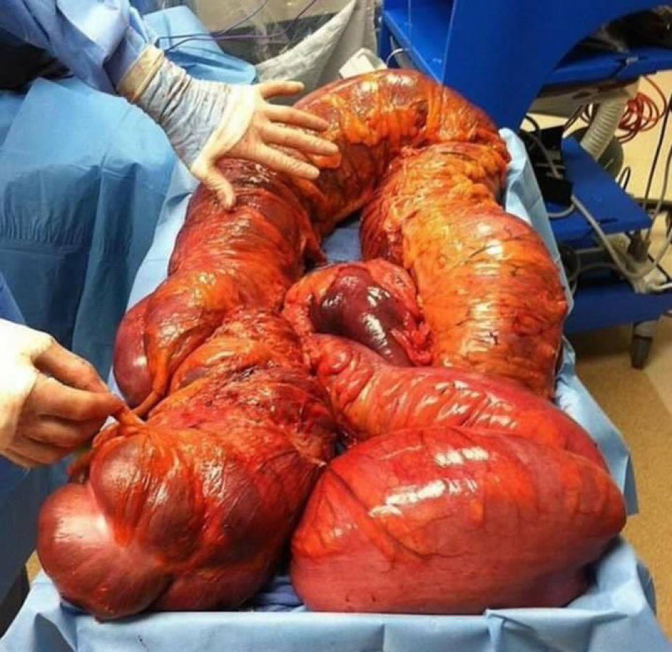 scientissimum's tweet photo. A 69-year-old male, residing in a nursing home since a cerebrovascular accident 14 years ago, and dealing with obesity, experienced altered mental status and a growing abdominal size. Despite conservative treatment, the significant colonic dilation observed on a CT scan led to an exploratory laparotomy, revealing Massive Colomegaly due to Recurrent Sigmoid Volvulus. 🎈 
#scientissimum #medtwitter #gastrotwitter 
.
References: Massive Colomegaly Due to Recurrent Sigmoid Volvulus
Max Wohlauer et. Al 
inspo @drkeithsiau