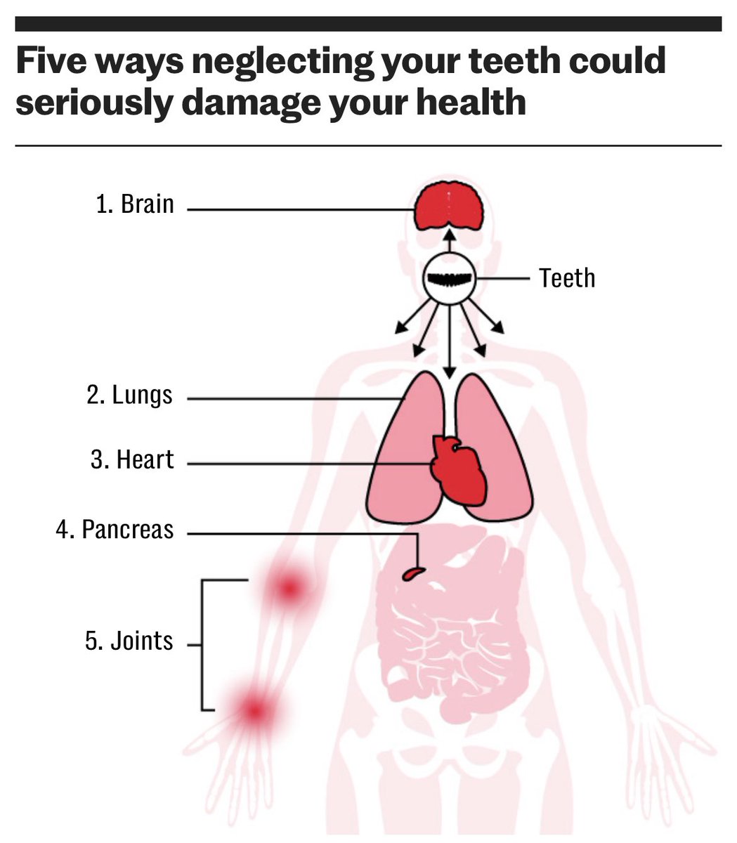TheBDA's tweet photo. “One of my good friends ended up in intensive care and almost died because he avoided getting some work done that I told him needed doing a year ago,” says says Paul Woodhouse @el_dentisto 

More on the health risks of not looking after your teeth👇
https://t.co/aKXg3uIypO https://t.co/28XXlsUbKv