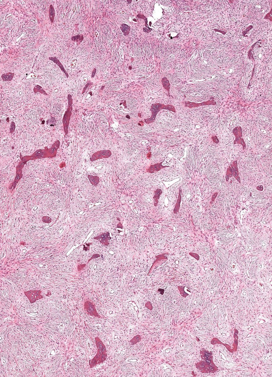 JMGardnerMD's tweet photo. Child with expansile intramedullary bone lesion.
What syndromes can this occur in? What gene mutation?
Answers & WSI digital slide: https://t.co/mRuBOeVmQ2
Video: https://t.co/QaUbUQeJQf
#BSTpath #pathologists #pathTwitter #orthotwitter #radpathmatch #radiology #radstwitter https://t.co/u2MXWnpjoq