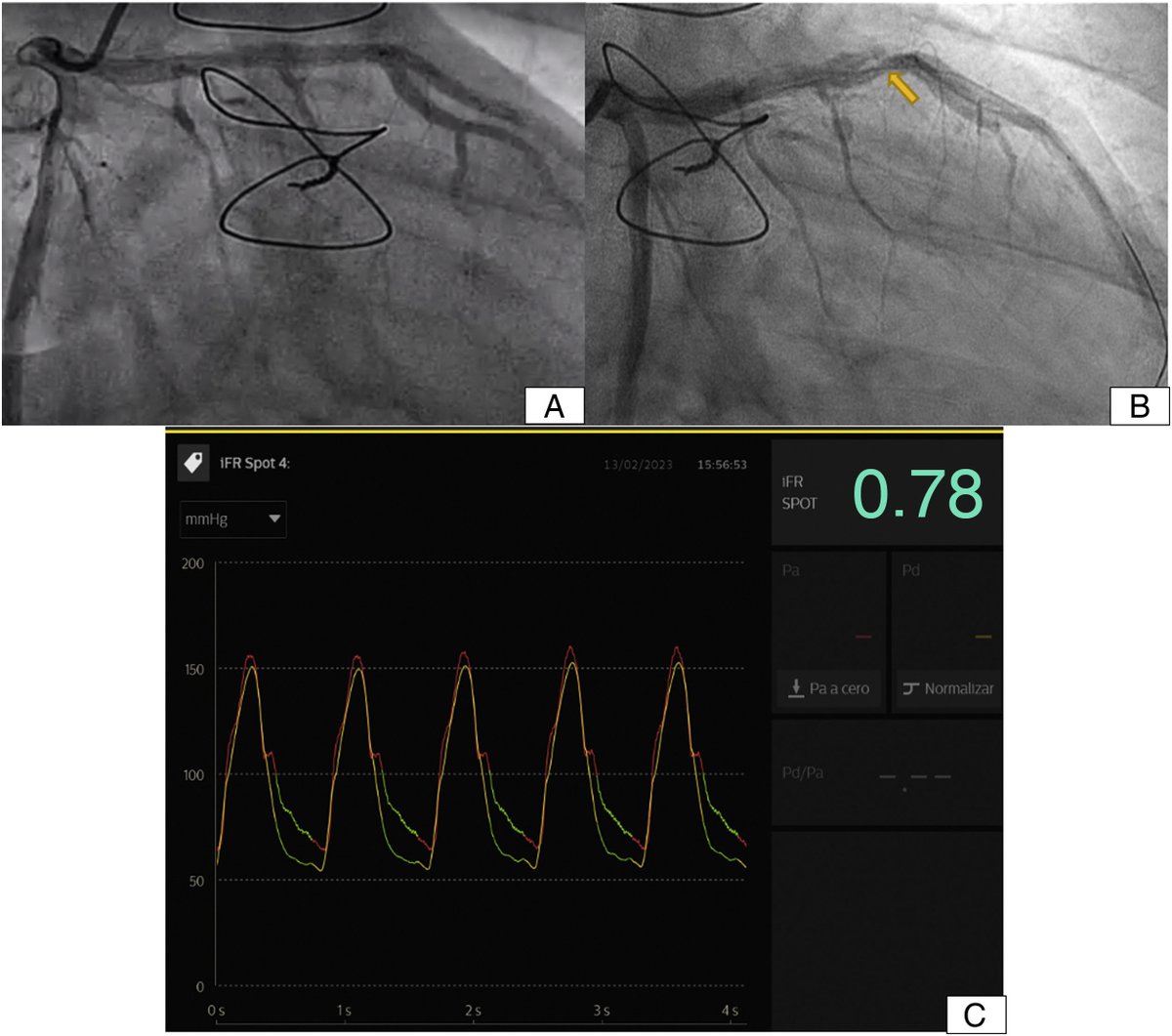 REC Publications (@revespcardiol) on Twitter photo Spontaneous coronary pseudoaneurysm following heart transplant #REC #AheadOfPrint <a href="/JesusPeM17/">Jesús Peña Mellado</a> revespcardiol.org//en-spontaneou… Spontaneous coronary pseudoaneurysm following heart transplant #REC #AheadOfPrint <a href="/JesusPeM17/">Jesús Peña Mellado</a> revespcardiol.org//en-spontaneou…