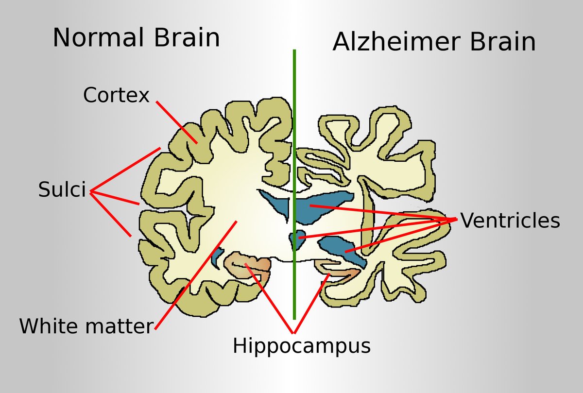 HealthAltox's tweet photo. Understanding Alzheimer’s Disease!
See the difference between normal and Alzheimer-affected brains. Alzheimer's is harmful to our lives. All details about causes, symptoms, and treatment are available on our site.

Click here for more details https://t.co/7WfjnGKKKC
@WHO @health https://t.co/xtM9GuD7MT