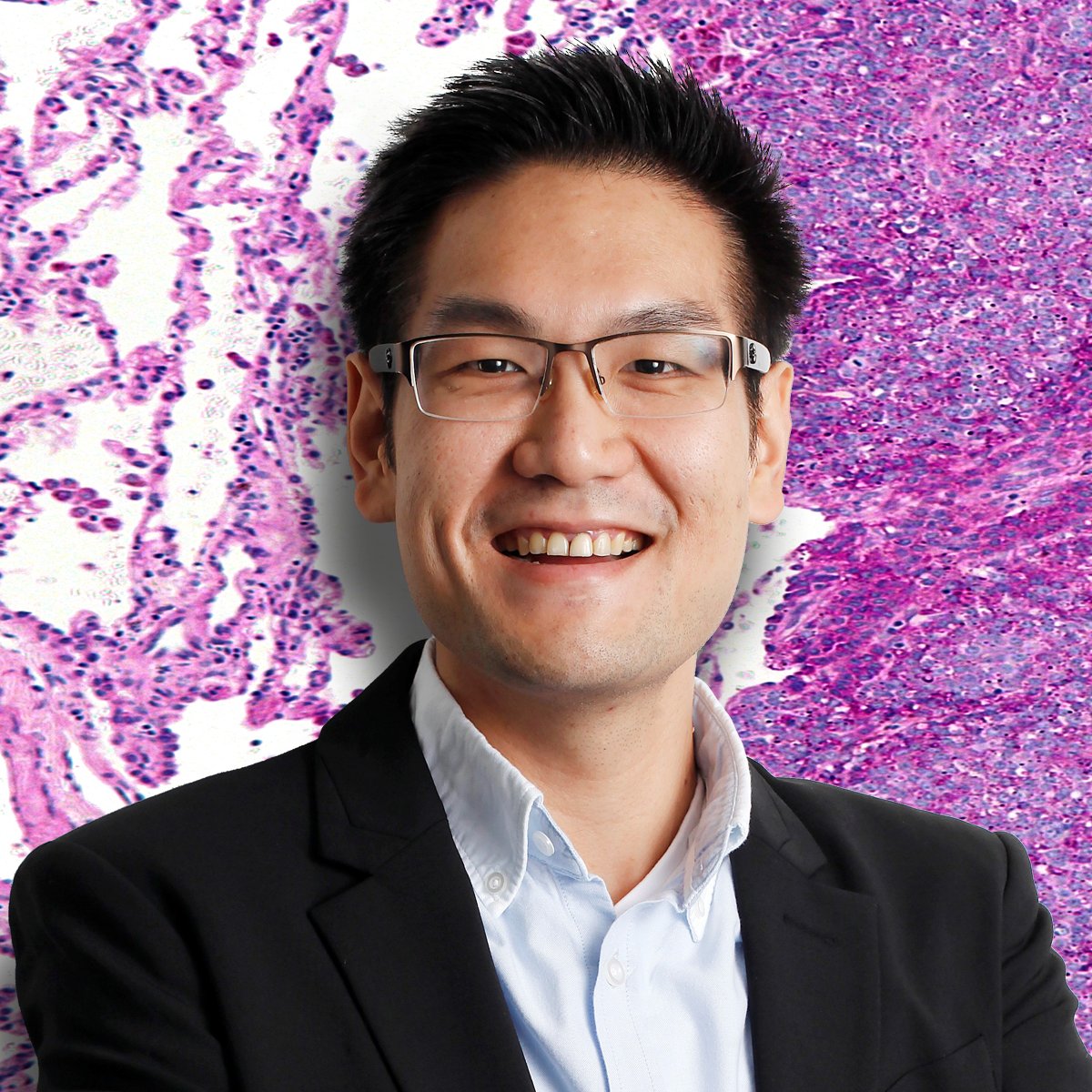 Bone Cancer Research Trust (@bcrt) on Twitter photo New year, new research announcement ๐ฌโจ
We are proud to welcome 2024 with a brand-new research project by Dr Huang <a href="/ICR_London/">The ICR</a>.
Thanks to funding from <a href="/BCRT/">Bone Cancer Research Trust</a>, <a href="/LPTrustUK/">Little Princess Trust</a> & @CCLG_UK, he hopes to identify patients likely to respond to specific treatments.
ow.ly/n0V950QqWlM New year, new research announcement ๐ฌโจ
We are proud to welcome 2024 with a brand-new research project by Dr Huang <a href="/ICR_London/">The ICR</a>.
Thanks to funding from <a href="/BCRT/">Bone Cancer Research Trust</a>, <a href="/LPTrustUK/">Little Princess Trust</a> & @CCLG_UK, he hopes to identify patients likely to respond to specific treatments.
ow.ly/n0V950QqWlM