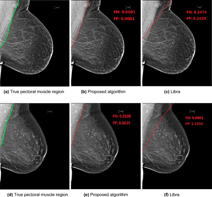 WUSTLphs's tweet photo. Simin Cheng, MS, Graham Colditz, MD, DrPH, Shu (Joy) Jiang, PhD, and @MIRimaging's Debbie Bennett, MD, propose a novel approach for improved accuracy/efficiency for pectoral muscle removal in mammography images. Read the article in Cancer Causes &amp; Control: https://t.co/eAPzCB33a0 https://t.co/ENV4DuJBnI