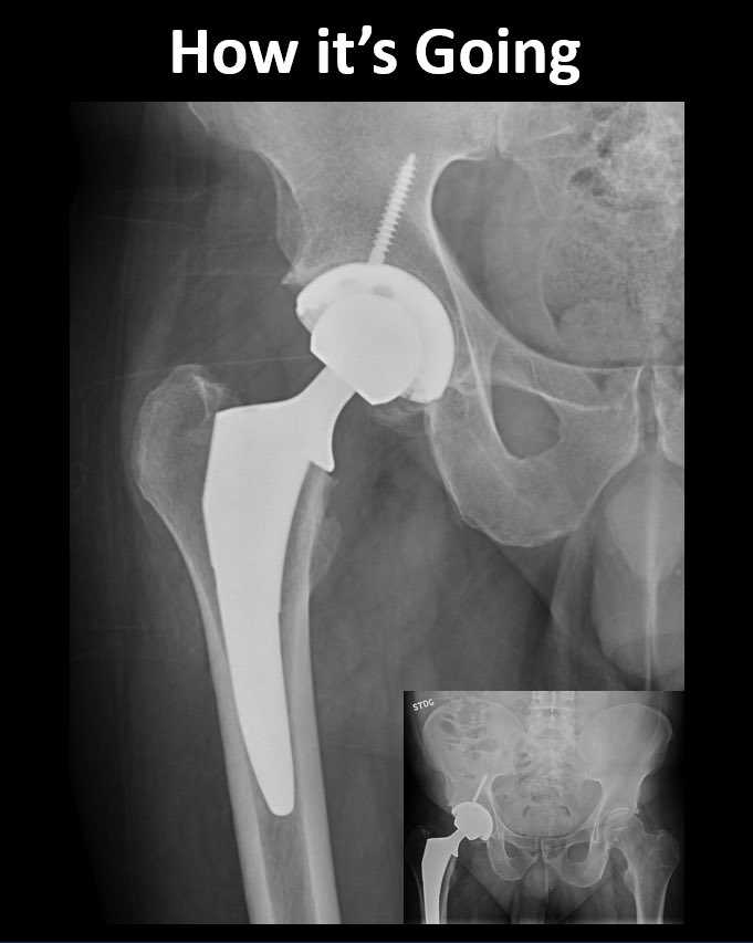 Hip function restoration comes in many forms, from #Repair to #Reconstruction and #Replacement. For those with substantial arthritis, #TotalHipArthroplasty such as through a muscle-sparing #DirectAnterior approach can restore function and get patients back to life and sport.